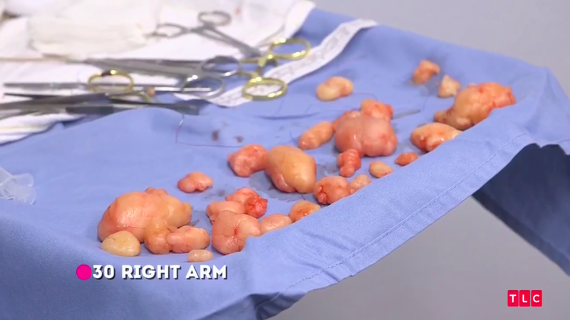 Illustration for article titled Dr. Pimple Popper Removes 68 Lipomas from One Person in Season 2 Premiere